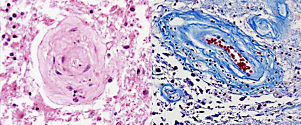 Small blood vessel damage in RVCL. On the left, interior blood vessel wall thickens restricting blood flow. On the right, collagen deposits in concentric circles inside vessel walls.
