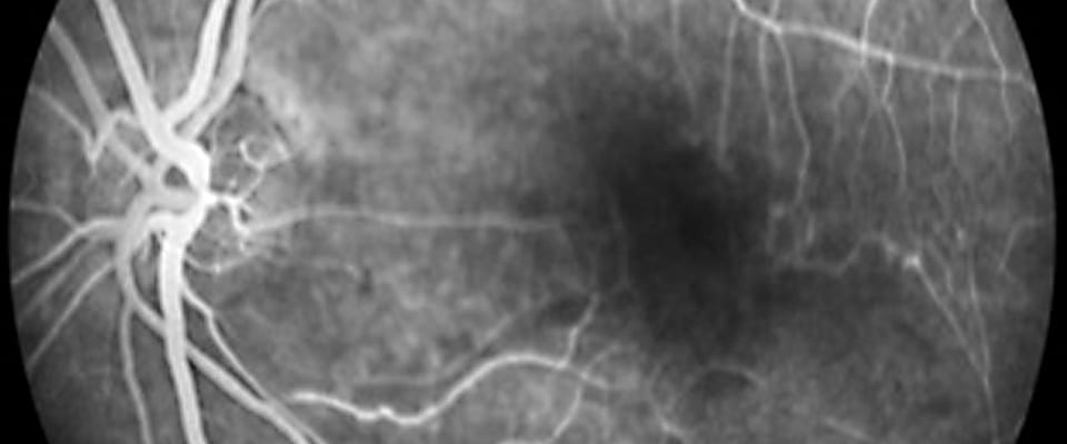 In RVCL blood vessels deteriorate. As seen in this picture of the retina of an RVCL patient, white areas show normal blood vessel growth, while the darkened area shows where blood vessels have "dropped out."